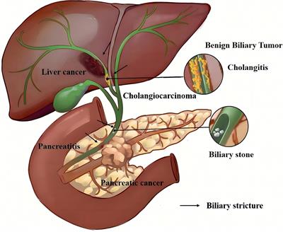 The past, present, and future of endoscopic management for biliary strictures: technological innovations and stent advancements